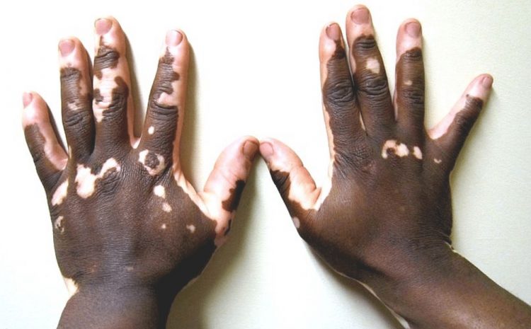 MPC contesta possível eliminação de candidatos com vitiligo