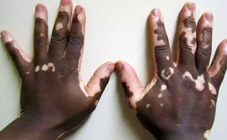  Vitiligo não impede participação em concurso da Aeronáutica